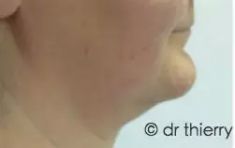 Chirurgie du double-menton - Résultat obtenu 6 jours après une liposuccion du cou. Il n’ y a pas d’ecchymoses. L’oedème est minime et pour cette raison on peut déjà observer une nette amélioration de l’ovale du visage. La transition entre le visage et le cou inexistante auparavant devient perceptible une semaine après la liposuccion.