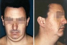 Liposuccion - Cliché avant - Dott. Andrea La Padula M.D.