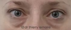 Dr Thierry Lemaire - Résultat 4 ans après deux séances de lipofilling des cernes dus à des poches sous les yeux.. Les cernes ont disparu sans faire de chirurgie des paupières (blépharoplastie)
