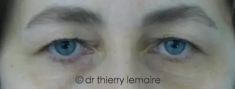 Opération des paupières supérieures - Photos avant et 4 mois après une chirurgie des paupières supérieures. L’excédent de peau donnait un aspect presque ténébreux au regard. La blépharoplastie supérieure a permis de rajeunir le regard et de mettre en valeur la couleur des yeux.