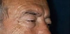 Blépharoplastie - Cliché avant - Dott. Andrea La Padula M.D.