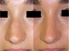 Septoplastie (opération de la cloison nasale) - Cliché avant - Dr Romain Viard