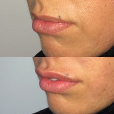 Augmentation des lèvres - Cliché avant - Dr Fabien Giausseran