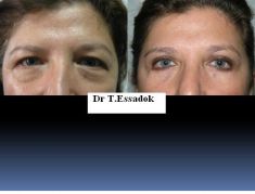 Blépharoplastie - Cliché avant - Dr Tayeb Essadok