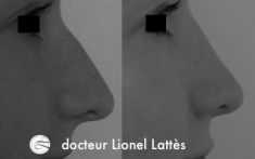 Rhinoplastie - Cliché avant - Dr Lionel Lattès