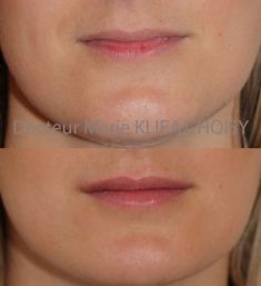 Augmentation des lèvres (acide hyaluronique) - http://www.chirurgie-esthetique-nice.fr/medecine-esthetique/injections/injections-acide-hyaluronique/