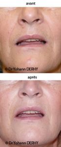 Lipofilling ou autogreffe de tissu graisseux - Cliché avant - Dr Yohann Derhy