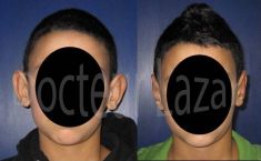 Dr Calin Constantin LAZAR - Correction voie ouverte à cicatrice rétro-auriculaire (enfant)