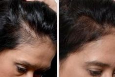 Greffe de cheveux - Cliché avant - Dr. Guesmi Marouen