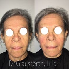 Lifting du visage - Cliché avant - Dr Fabien Giausseran