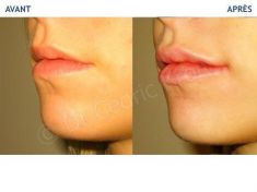 Augmentation des lèvres - Cliché avant - Dr Cédric Kron