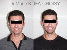 Otoplastie (Chirurgie esthétique des oreilles) - Cliché avant - Dr Marie Klifa-Choisy