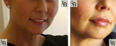 Augmentation des lèvres (acide hyaluronique) - Cliché avant - Dr Laurent Benadiba M.D