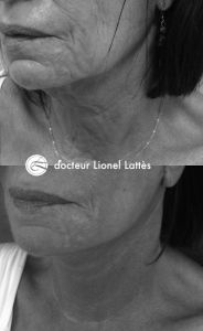 Lifting du visage - Cliché avant - Dr Lionel Lattès