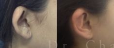 Otoplastie (Chirurgie esthétique des oreilles) - Cliché avant - Dr Chedi Bali