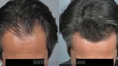 Greffe de cheveux - Cliché avant - Dr. Guesmi Marouen