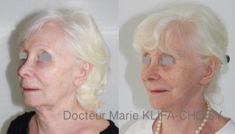 Lifting du visage - http://www.chirurgie-esthetique-nice.fr/chirurgie-esthetique/chirurgie-du-visage/liftings-du-visage/