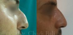 Rhinoplastie - Cliché avant - Dr Chedi Bali