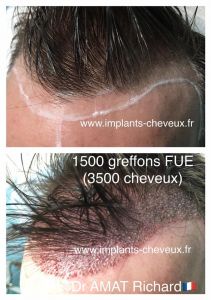 Dr AMAT - Micro-greffe cheveux FUE 2.0 - Cliché avant - Dr AMAT - Micro-greffe cheveux FUE 2.0