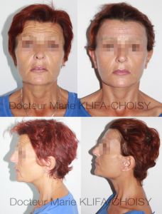 Lifting du visage - Cliché avant - Dr Marie Klifa-Choisy