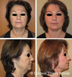 Lifting Facial Silhouette Soft - Cliché avant - Dr Thierry KTORZA