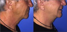 Lifting du visage - Cliché avant - Dr Alexandre Mertens