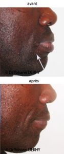 Augmentation des lèvres - Cliché avant - Dr Yohann Derhy