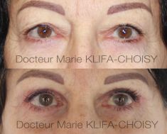 Blépharoplastie - Cliché avant - Dr Marie Klifa-Choisy