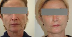Lifting du visage - Lifting associant un lifting medio facial et un lifting cervico facial dans la même procedure