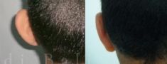 Otoplastie (Chirurgie esthétique des oreilles) - Cliché avant - Dr Chedi Bali
