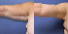 Lifting des bras - Réduction de la peau du gras des deux bras