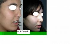 Rhinoplastie - Rhinoplastie de reconstruction pour nez traumatique en réutilisant le cartilage septal