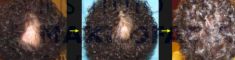 Traitements de la chute des cheveux - Cliché avant - Prof Abdeslam Benajiba