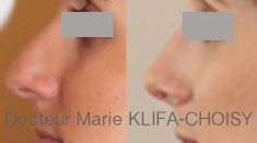 Dr Marie Klifa-Choisy - http://www.chirurgie-esthetique-nice.fr/chirurgie-esthetique/chirurgie-du-visage/rhinoplastie/