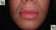 Augmentation des lèvres - Cliché avant - Dr Laurent Benadiba M.D