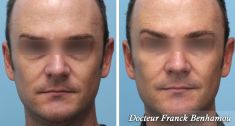 Lifting du visage - Cliché avant - Dr Franck Benhamou