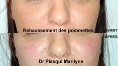 Dr Marilyne Plasqui - Réharmonisation de la partie médiane du visage par injection d