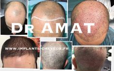 Greffe de cheveux - Cliché avant - Dr AMAT - Micro-greffe cheveux FUE 2.0