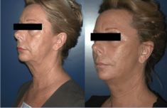Lifting Facial Silhouette Soft - Cliché avant - Dr Simon Lamquin