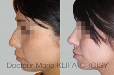 Dr Marie Klifa-Choisy - http://www.chirurgie-esthetique-nice.fr/chirurgie-esthetique/chirurgie-du-visage/rhinoplastie/http://www.chirurgie-esthetique-nice.fr/chirurgie-esthetique/chirurgie-du-visage/rhinoplastie/