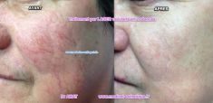 Traitements laser - dermatologie esthétique - Cliché avant - Dr Richard Amat Centre de Micro-greffe de cheveux FUE