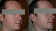 Dr Jacques Buis - Lifting de la partie médiane du visage ayant une action sur l’excès de peau de la paupière inférieure, les poches, les cernes, la pommette, le sillon nasogénien, le pli d’amertume et la bajoue