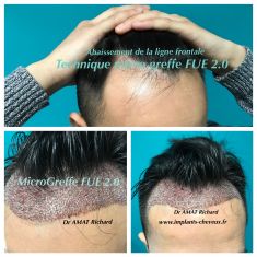 Greffe de cheveux - Micro greffe capillaire FUE 2.0 new dense, sans cicatrice et sans douleur.
implants-cheveux.fr