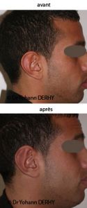 Otoplastie (Chirurgie esthétique des oreilles) - Cliché avant - Dr Yohann Derhy