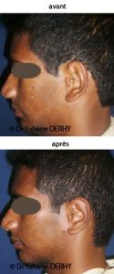Otoplastie (Chirurgie esthétique des oreilles) - Cliché avant - Dr Yohann Derhy