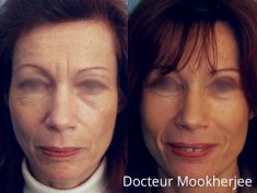 Lifting du visage - Cliché avant - Dr Robin Mookherjee