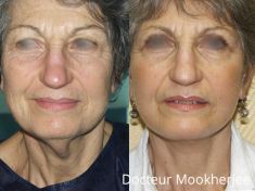 Lifting du visage - Cliché avant - Dr Robin Mookherjee