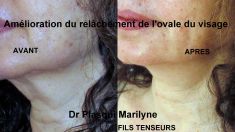 Lifting non chirurgical - Traitement liftant du bas du visage par fils tenseurs, résultats (photos après ) à 1 an.