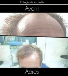 Traitements de la chute des cheveux - Cliché avant - Dr Alice de Taddeo