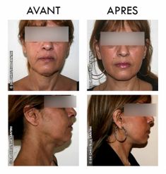 Lifting du visage - Cliché avant - Dr Christelle Santini